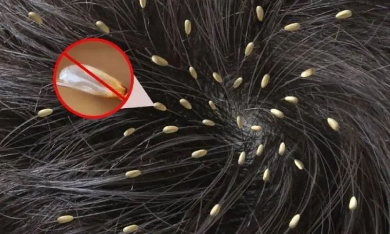 Mơ thấy con chấy đánh con gì? Mơ thấy chấy rận trên đầu