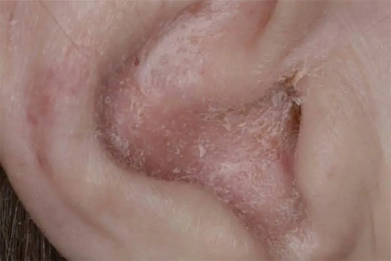Dị ứng da hoặc kích ứng