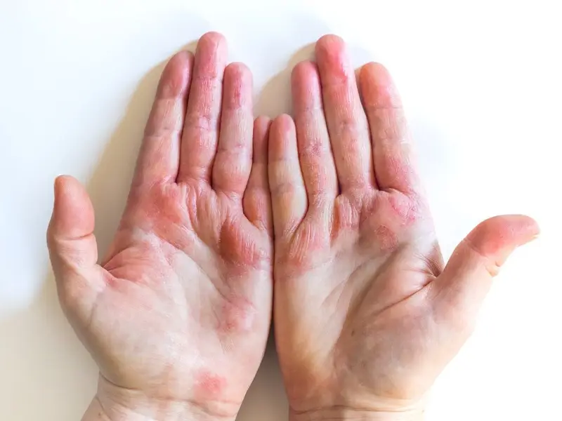 Ngứa lòng bàn tay trái là điềm báo gì theo quan niệm dân gian?